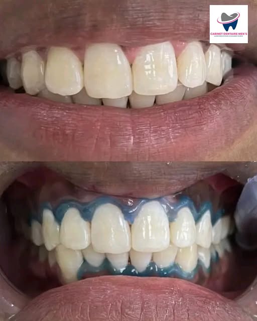 Blanchiment dentaire - Cas 6